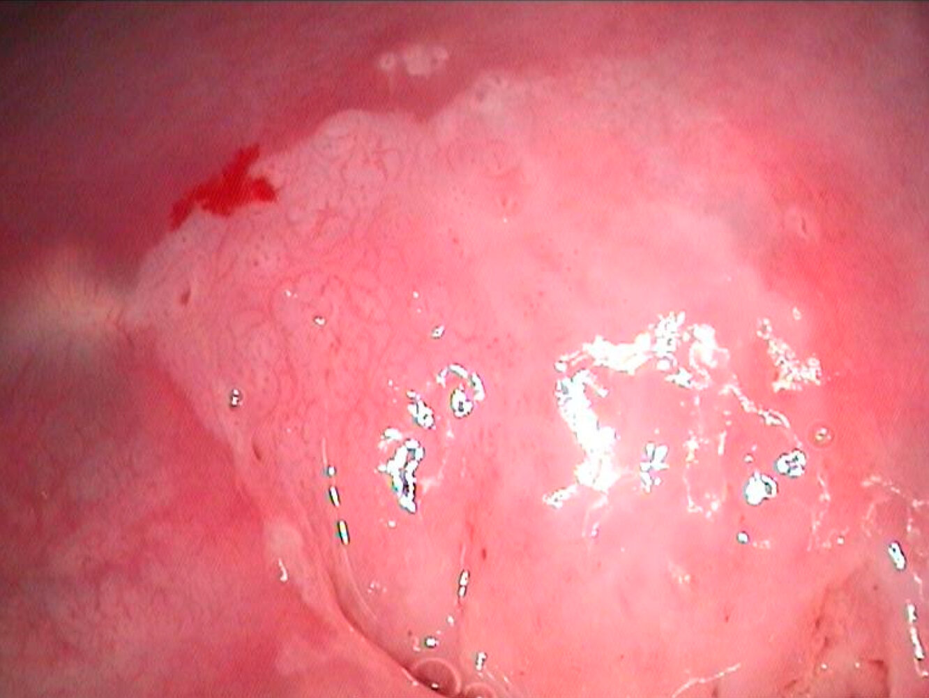 High-grade squamous intraepithelial lesion of the cervix (HSIL)