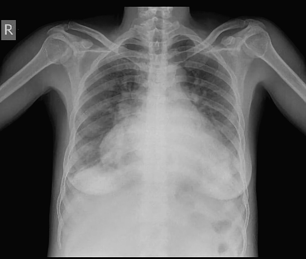 High output cardiac failure