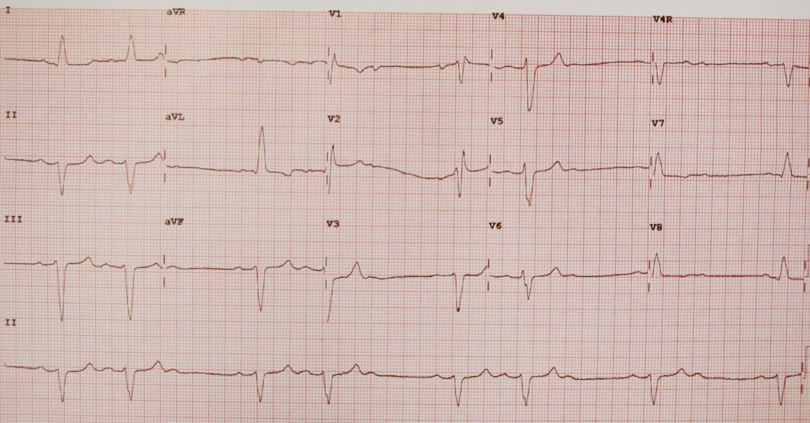 Mobitz type II second-degree atrioventricular block and bifascicular block