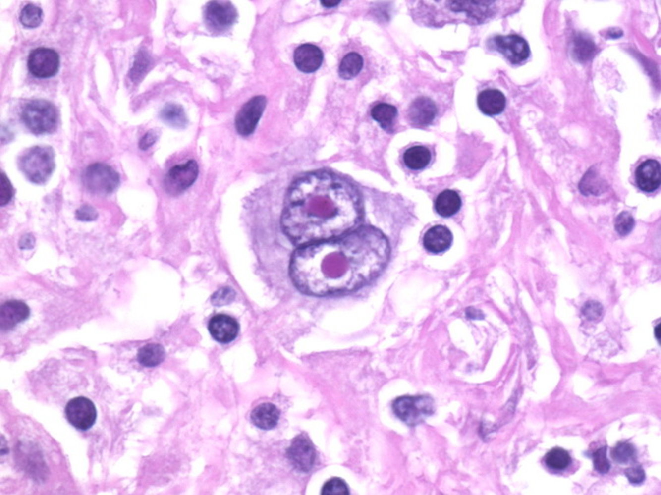 Reed-Sternberg cell