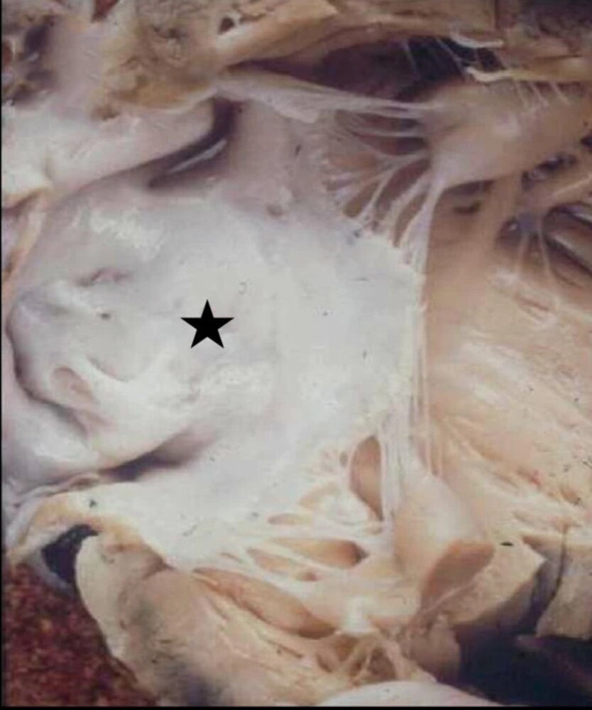 Endocardial fibroelastosis