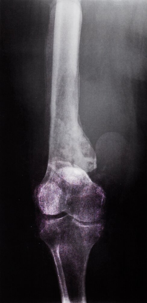 Osteosarcoma