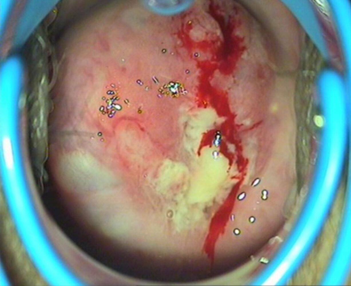 High-grade squamous intraepithelial lesion (HSIL) of the cervix