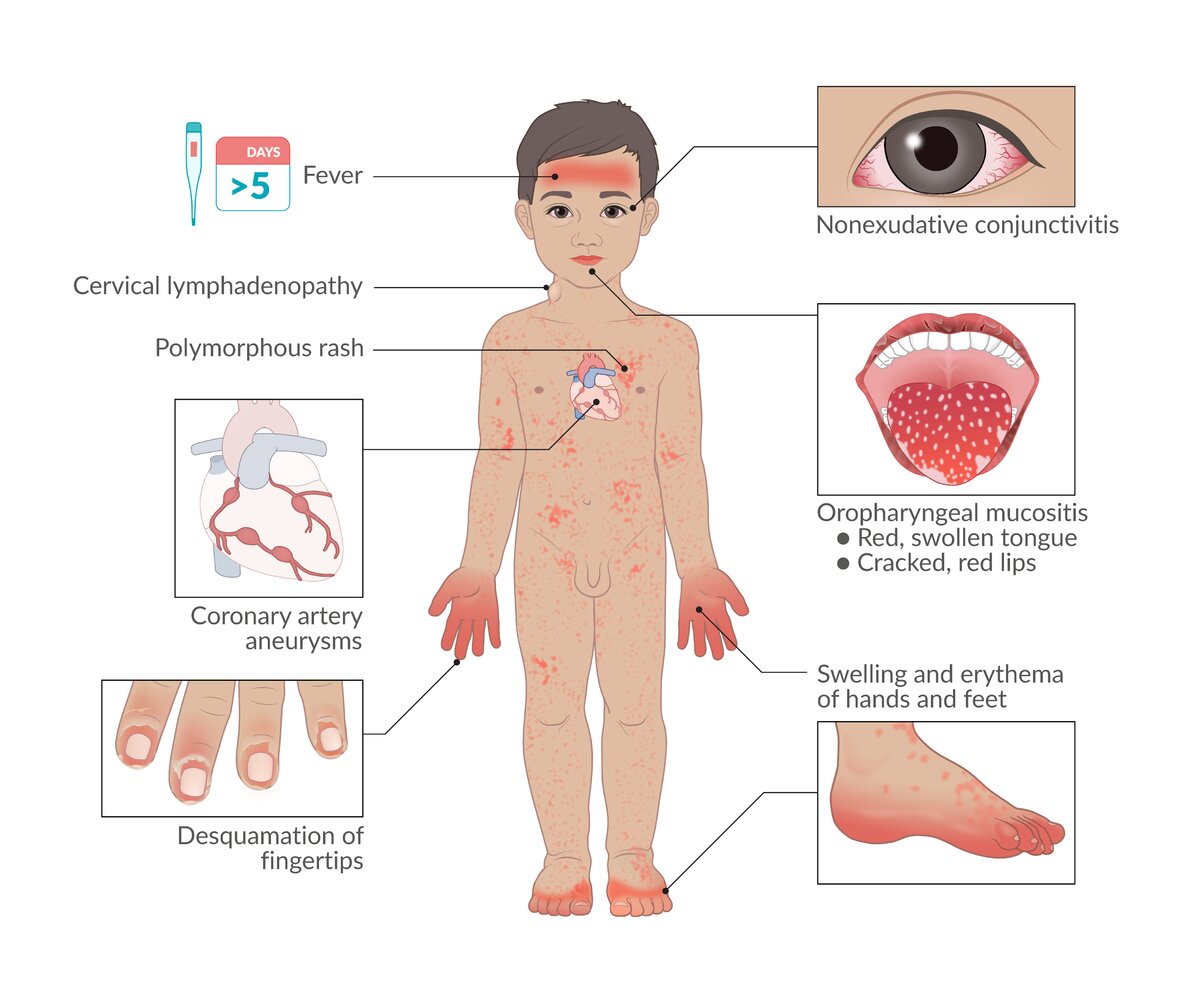 Clinical features of Kawasaki disease