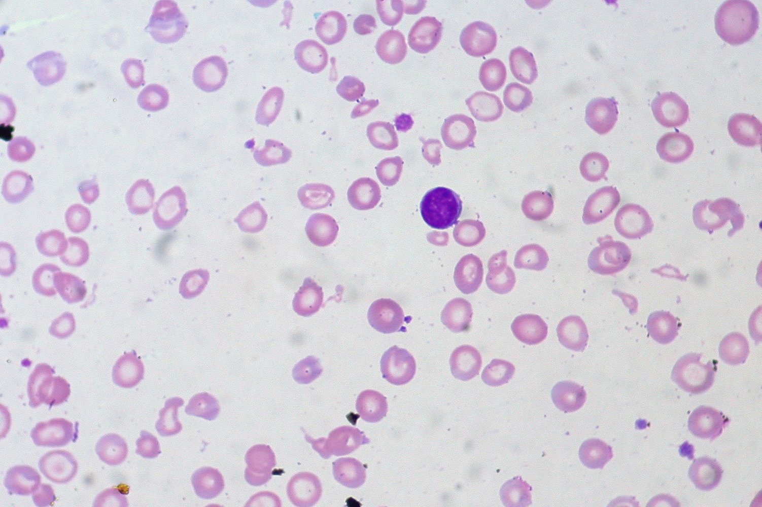 Iron deficiency anemia