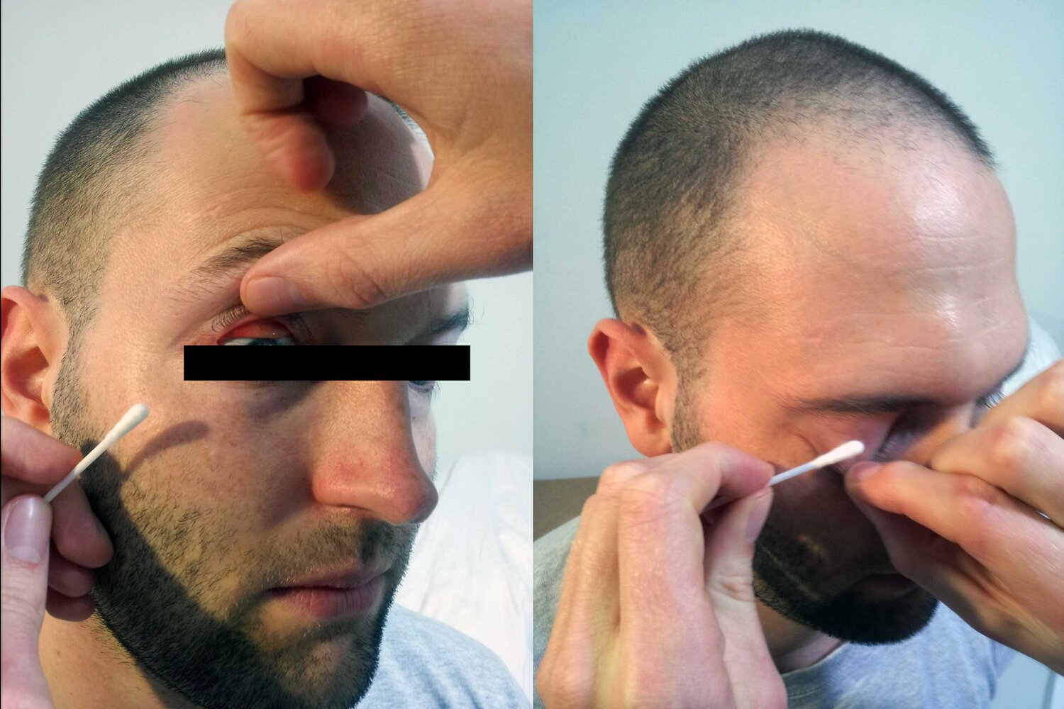 Eversion of the upper eyelid