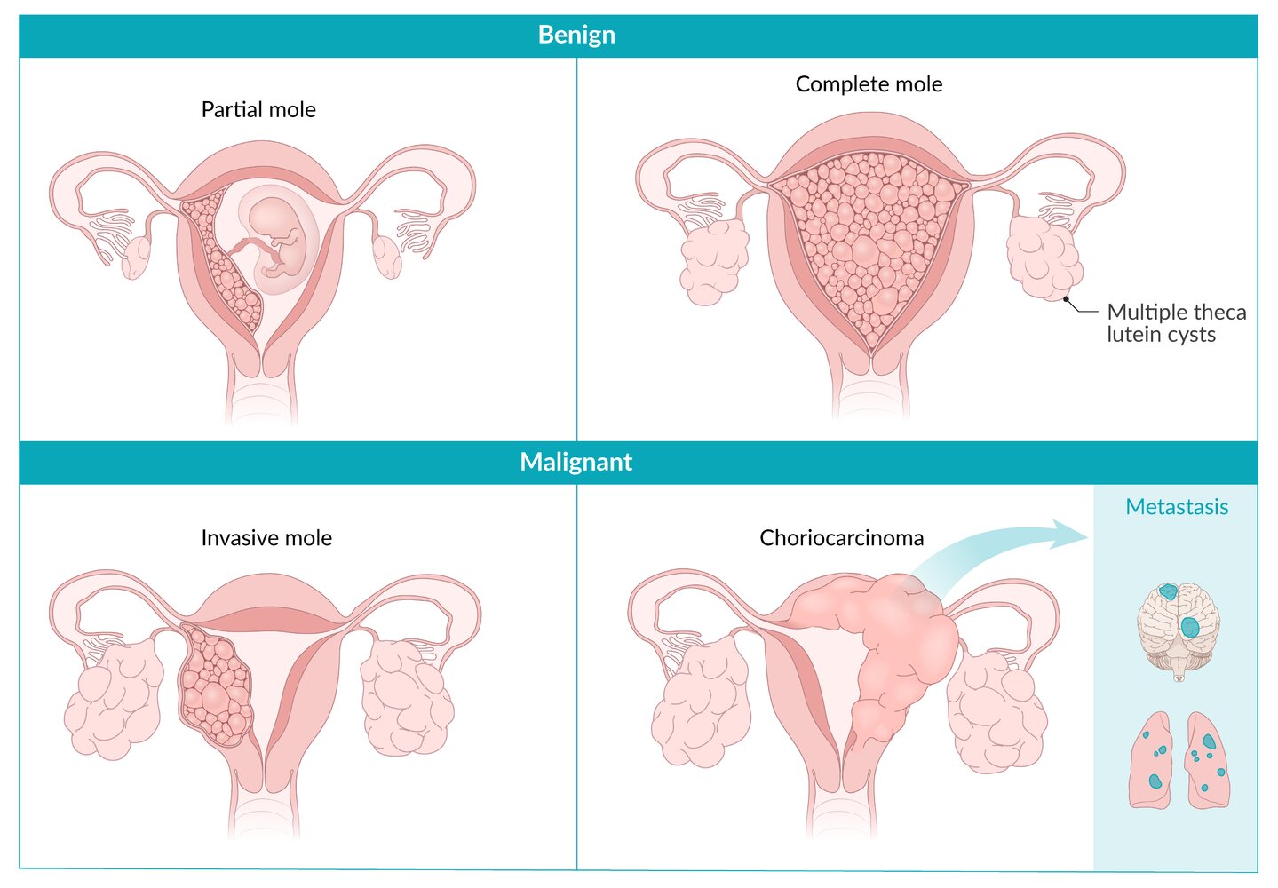 Types of gestational trophoblastic disease (GTD)