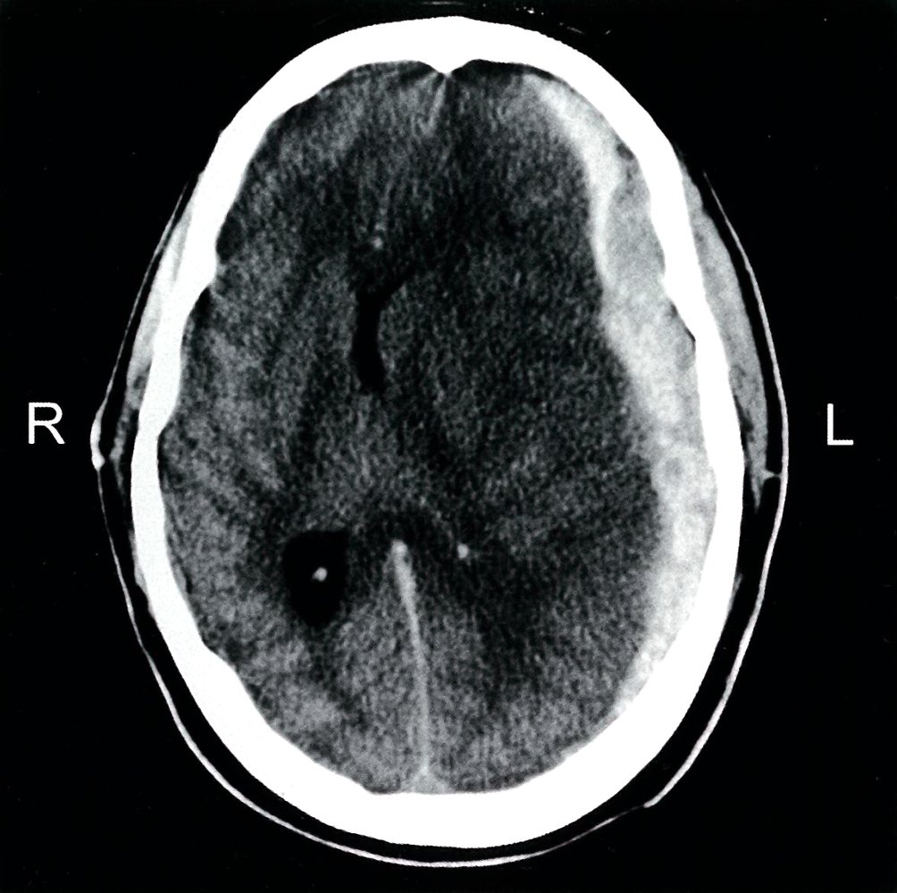 Subdural hematoma and cerebral edema