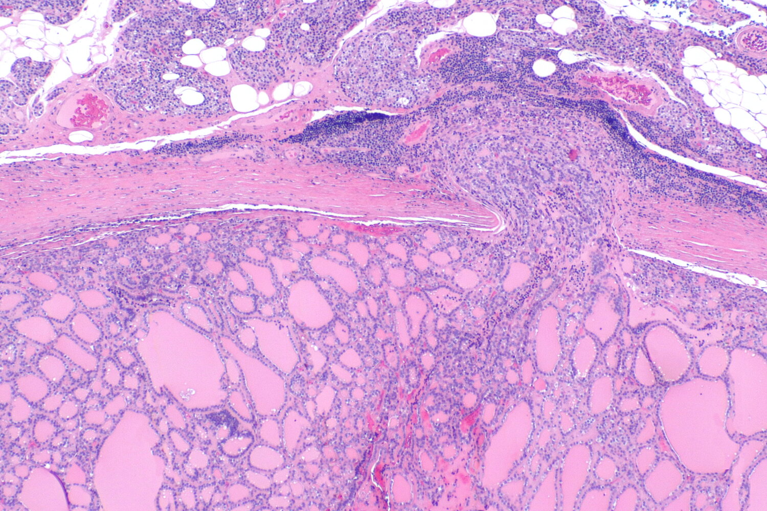 Follicular thyroid carcinoma
