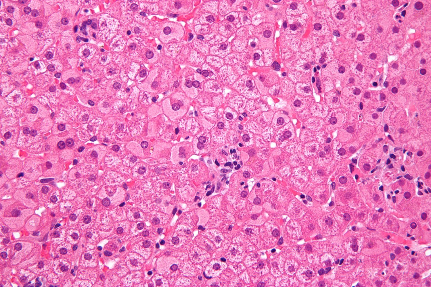Chronic hepatitis B