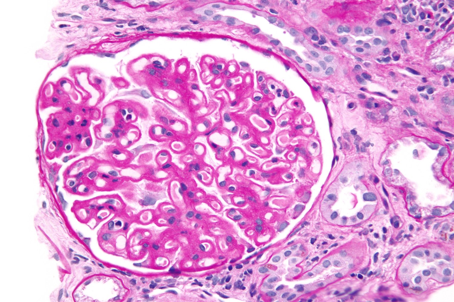 Membranous nephropathy