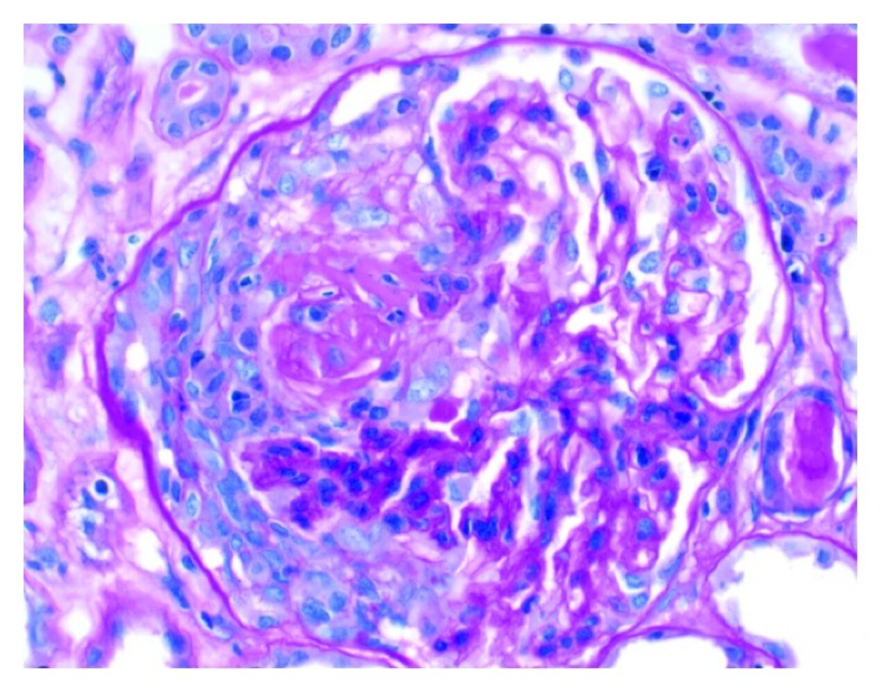 Crescent formation in rapidly progressive glomerulonephritis (RPGN)