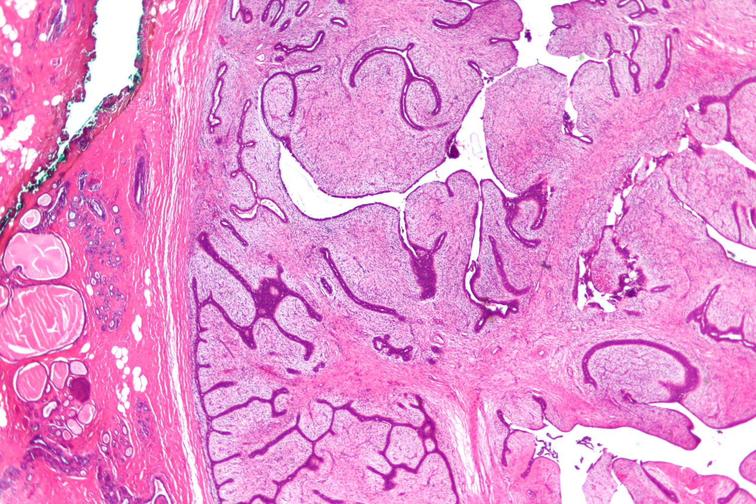 Phyllodes tumor