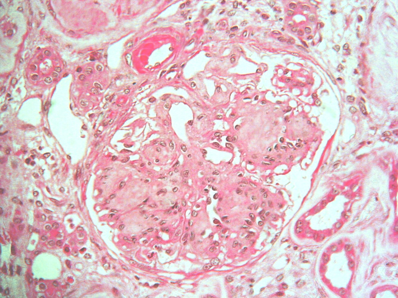 Diabetic nephropathy
