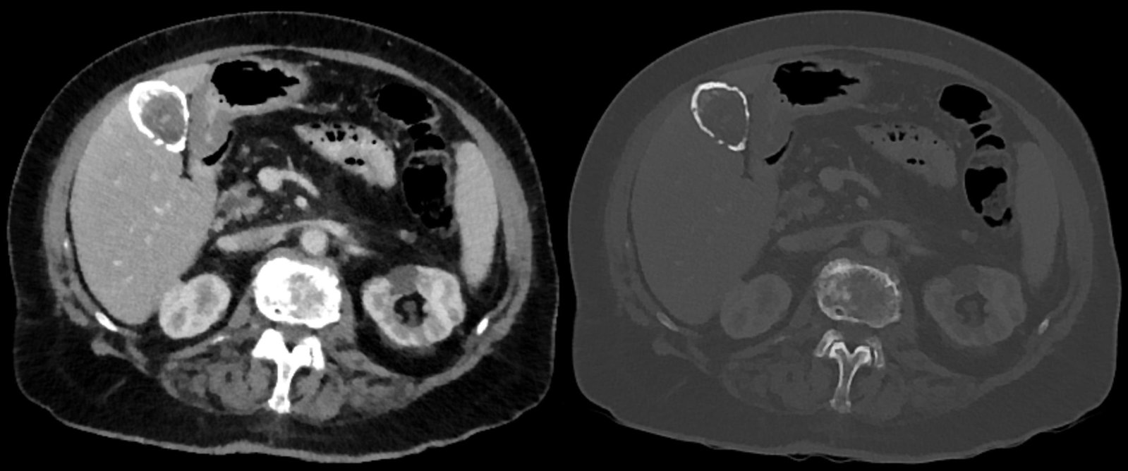 Porcelain gallbladder