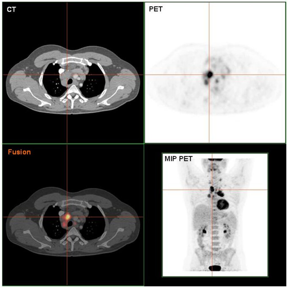 PET-CT of lymphadenopathy in Hodgkin lymphoma