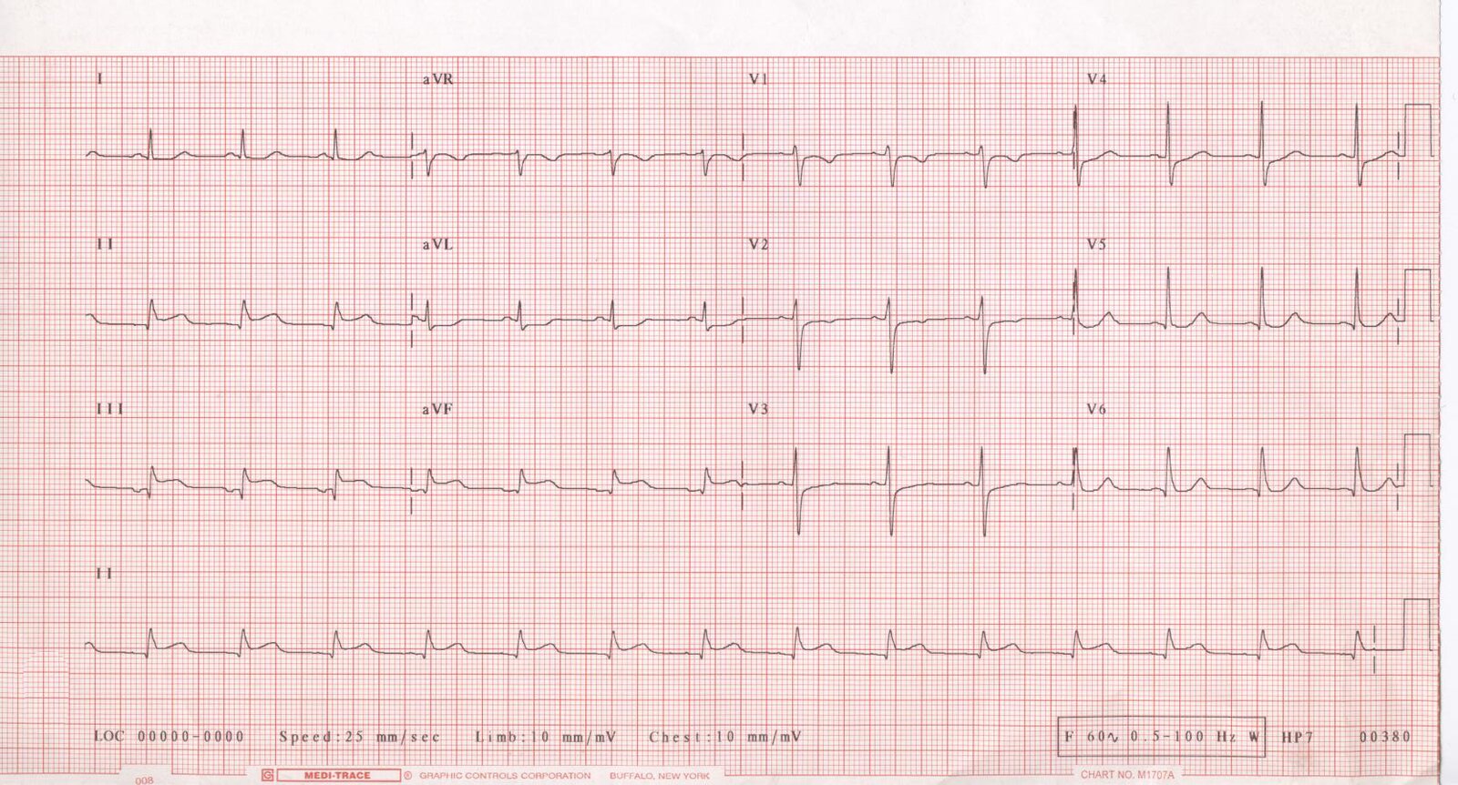 Acute inferior ST-segment elevation myocardial infarction (STEMI)