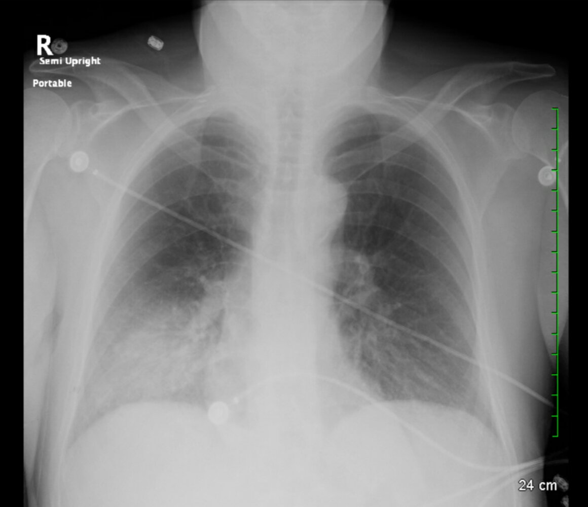 Air space opacification from Pneumonia