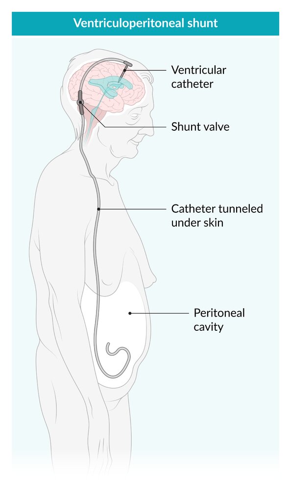 Ventriculoperitoneal shunt