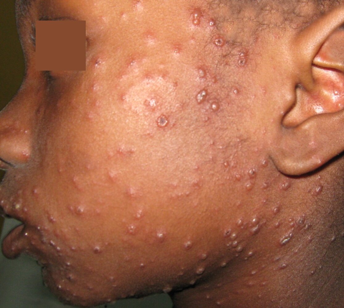 Chickenpox