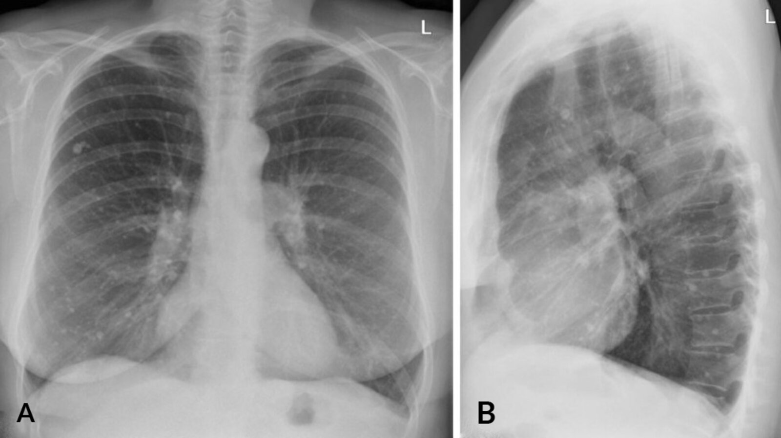 Multiple small calcified pulmonary nodules