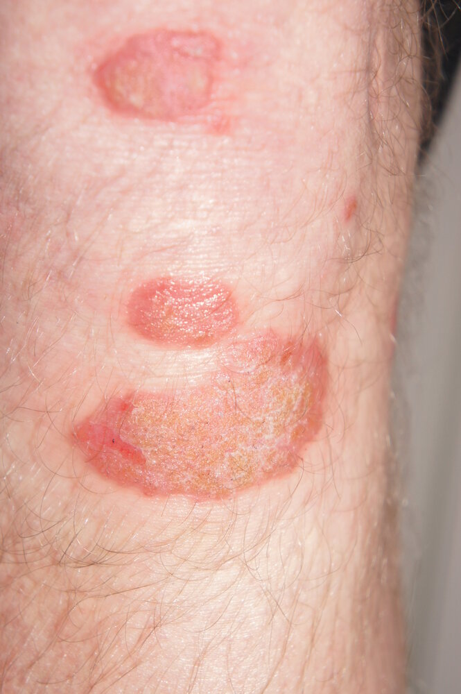 Psoriasis with Auspitz sign