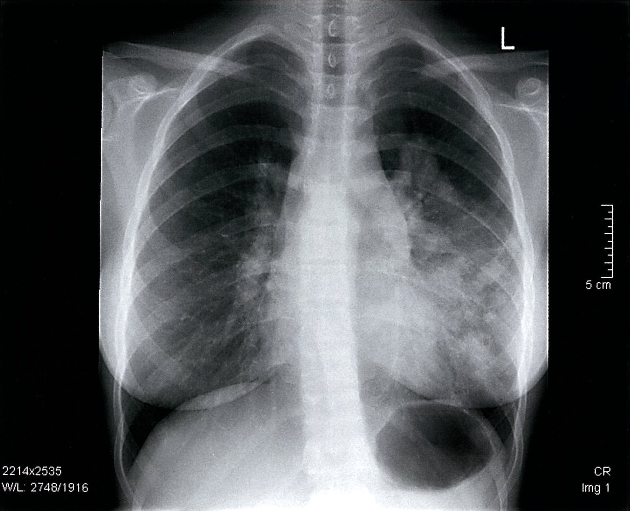 Lymphoma
