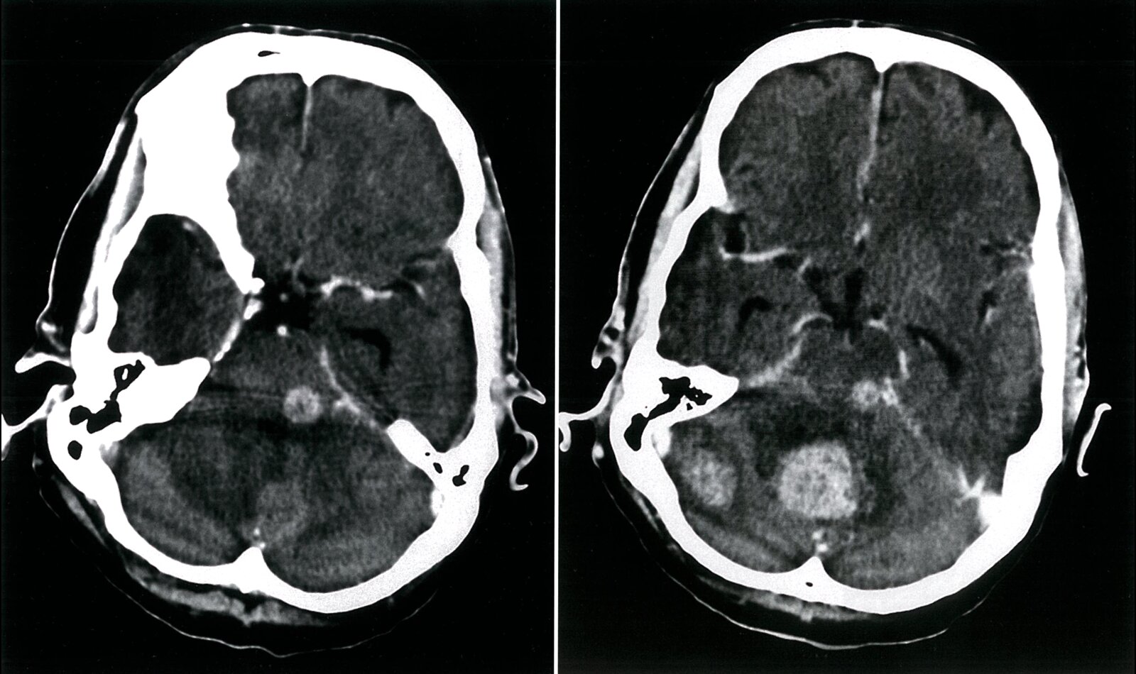 Brain metastases in lung cancer