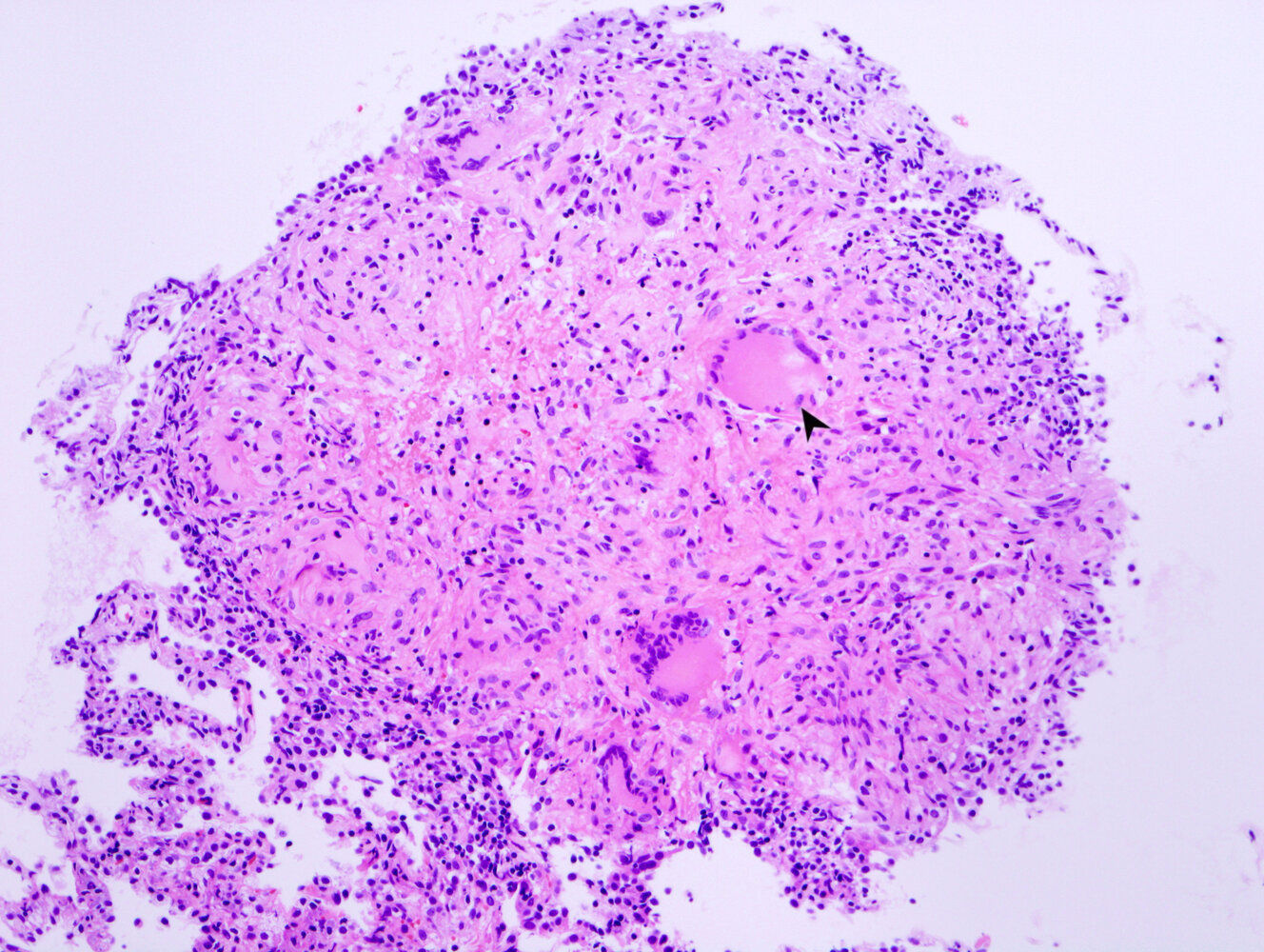 Tuberculous granuloma with Langhans cells
