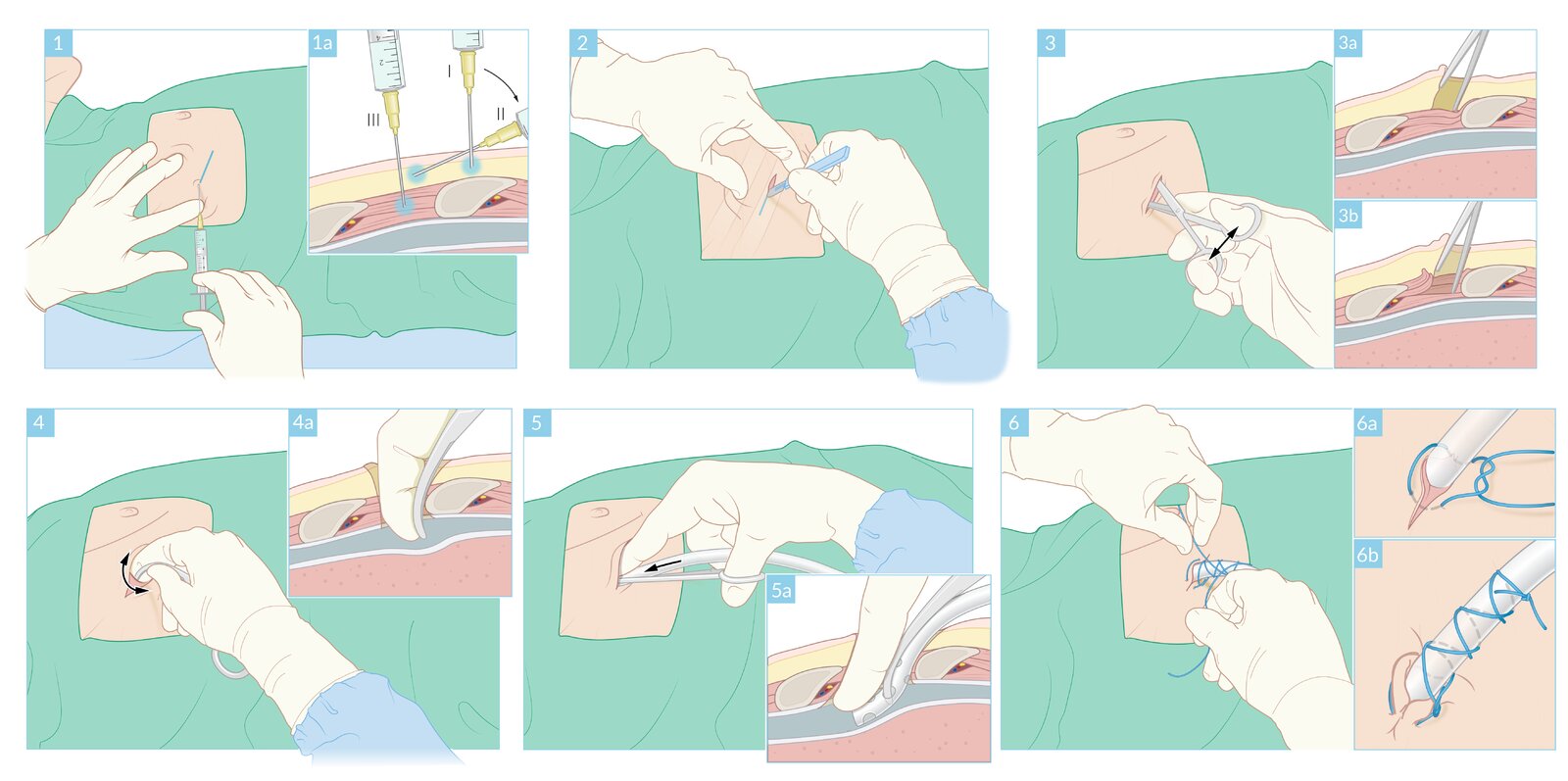 Chest tube placement