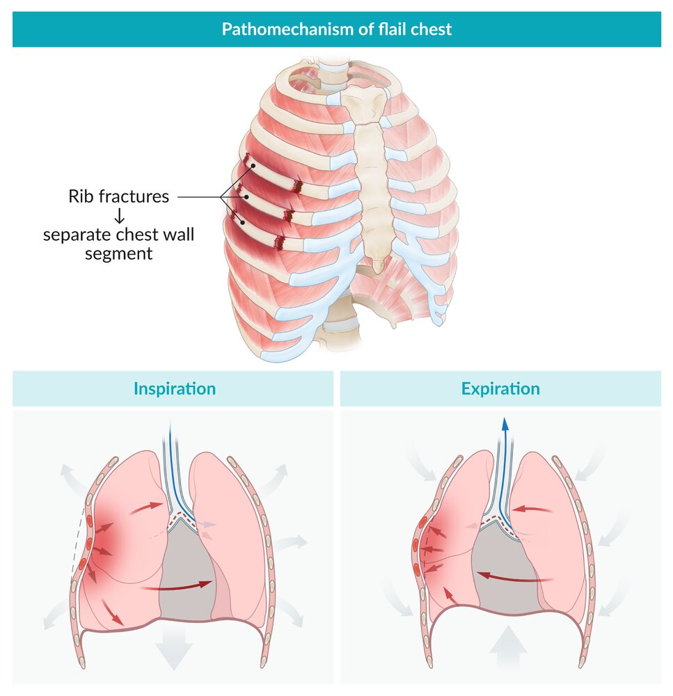 Pathomechanism of flail chest