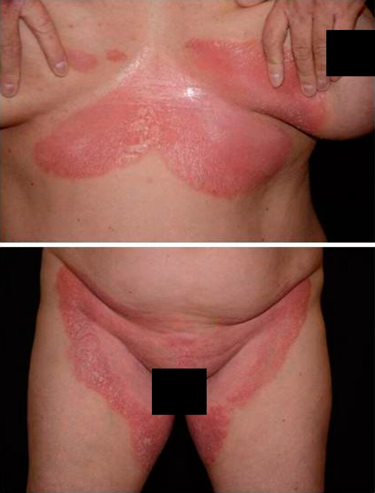 Inverse psoriasis