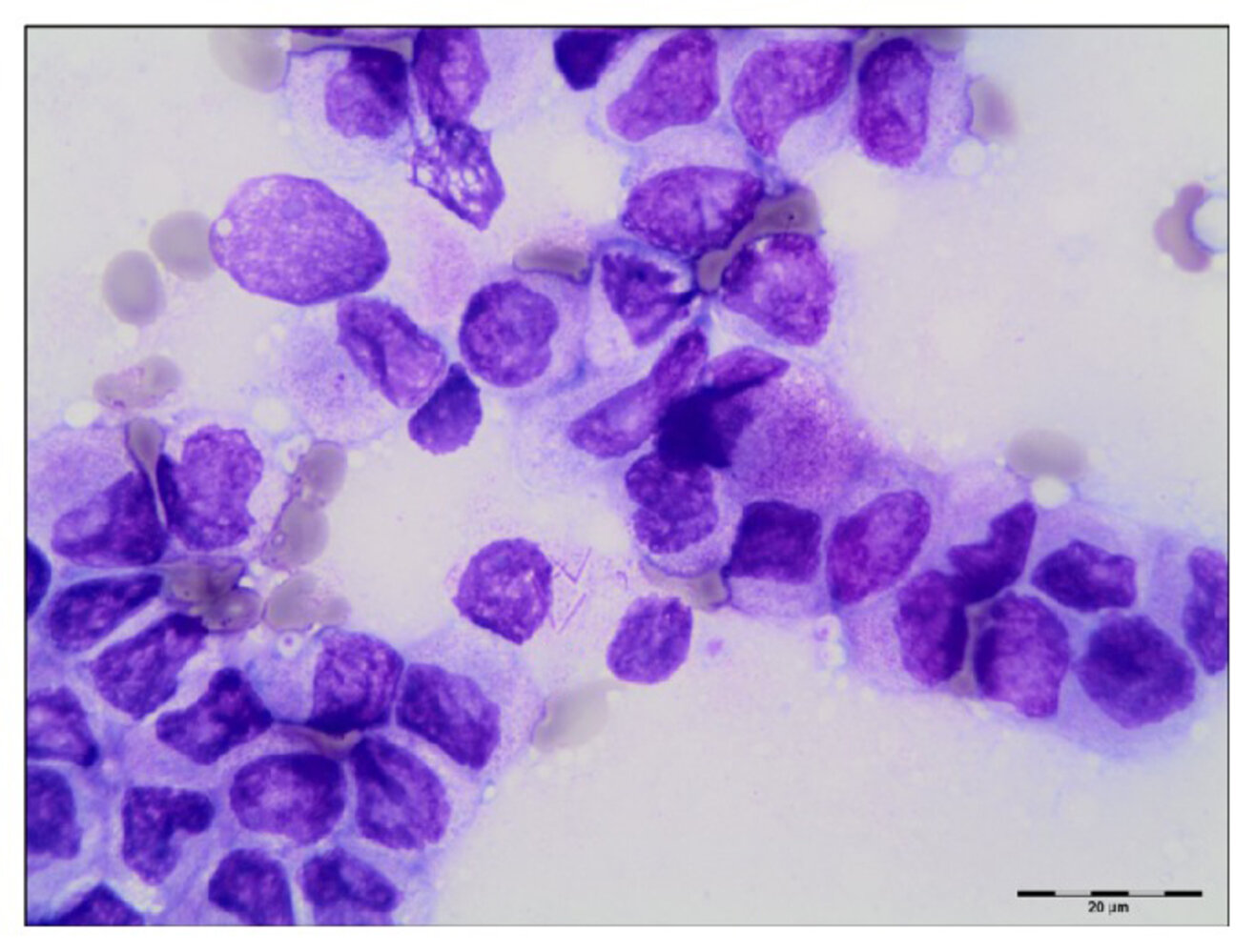 Auer rods in acute promyelocytic leukemia (APL)