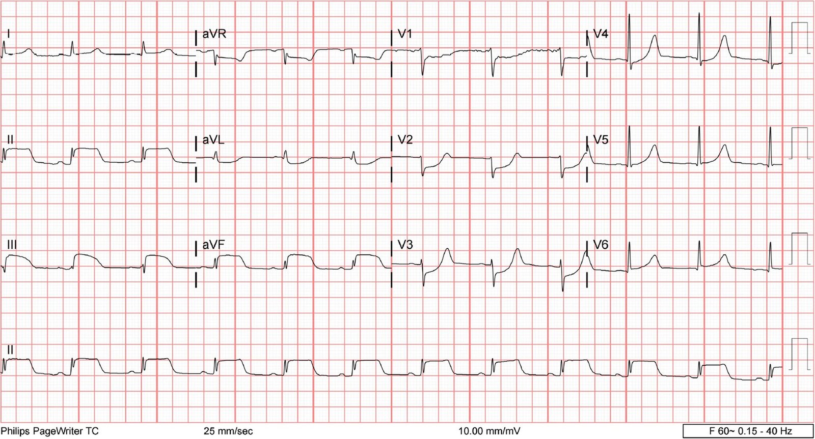 Inferoposterior myocardial infarction