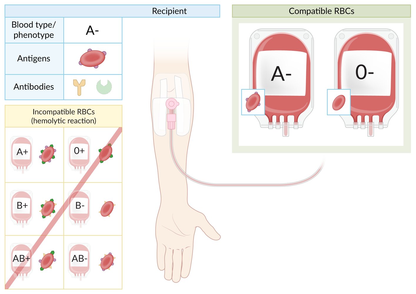 Blood type A- RBC transfusion compatibility