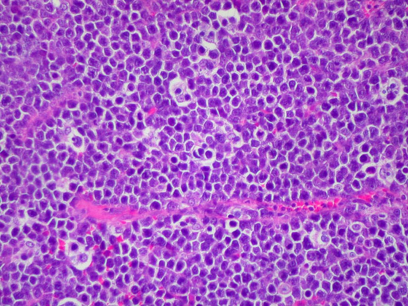 Burkitt lymphoma