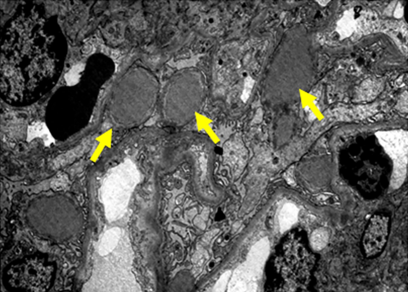 Postinfectious glomerulonephritis (PIGN)