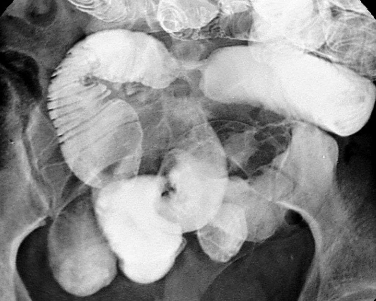 Small bowel stricture in Crohn disease