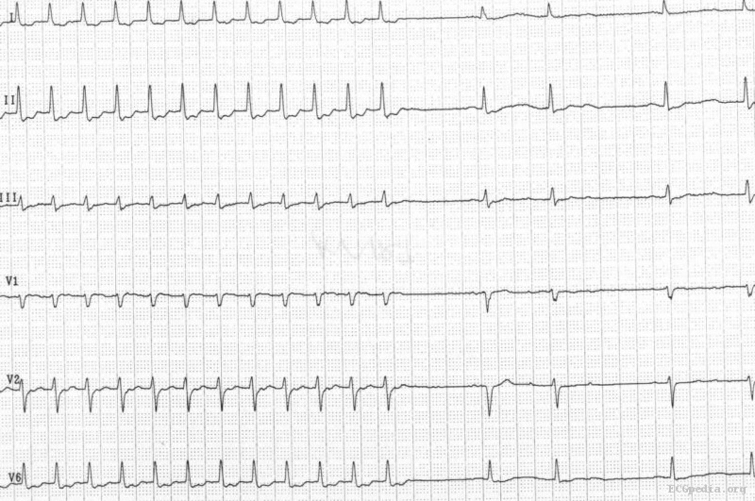 Atrioventricular nodal reentry tachycardia (AVNRT)