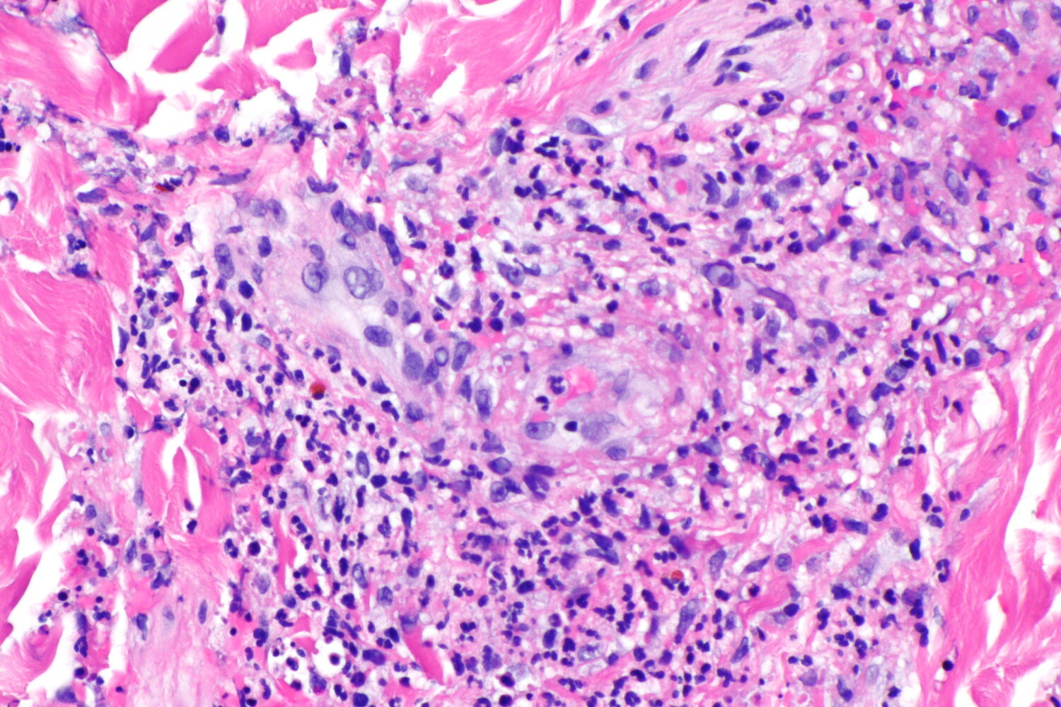 Leukocytoclastic vasculitis