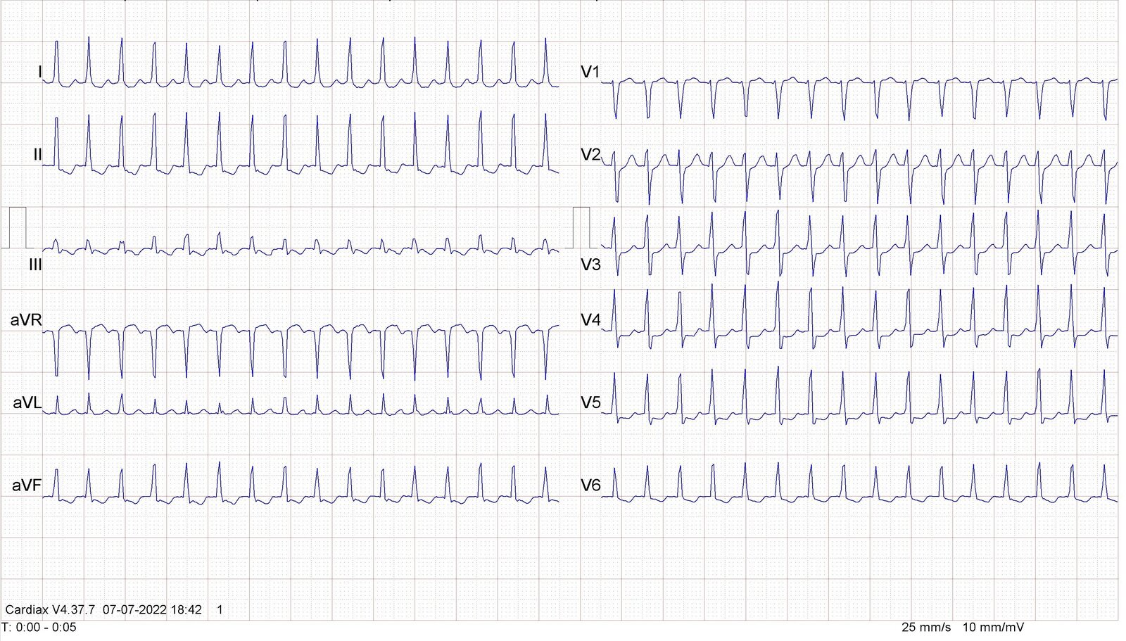 Atrioventricular nodal reentrant tachycardia (AVNRT)