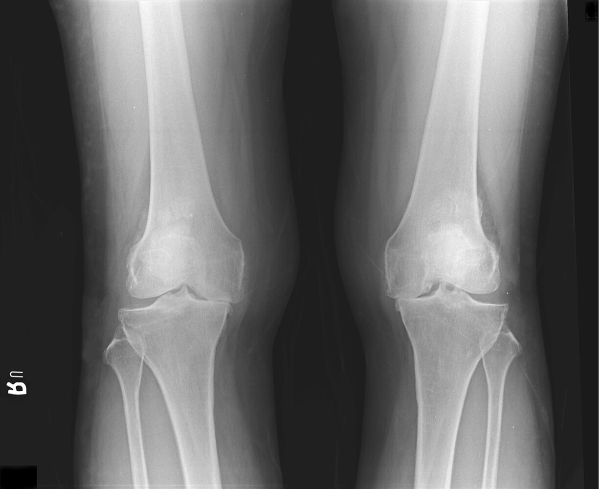 Osteoarthritis of the knee