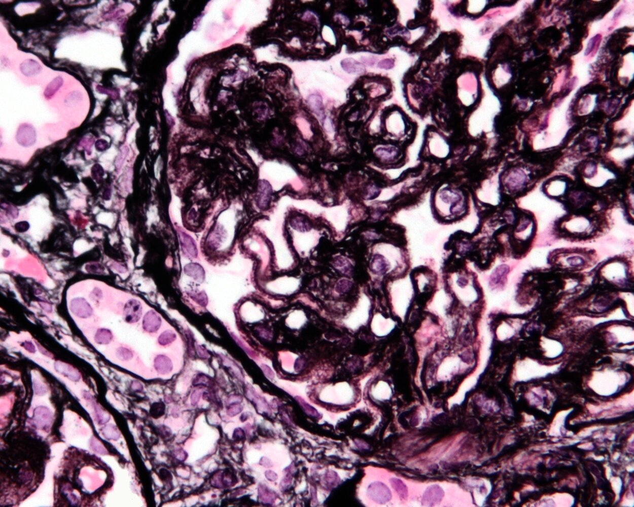 Membranous nephropathy