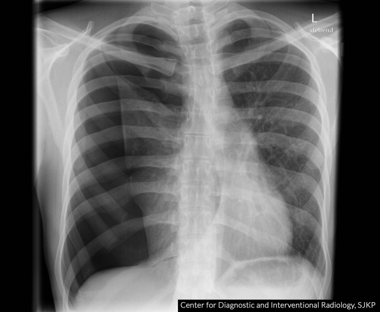 Tension pneumothorax