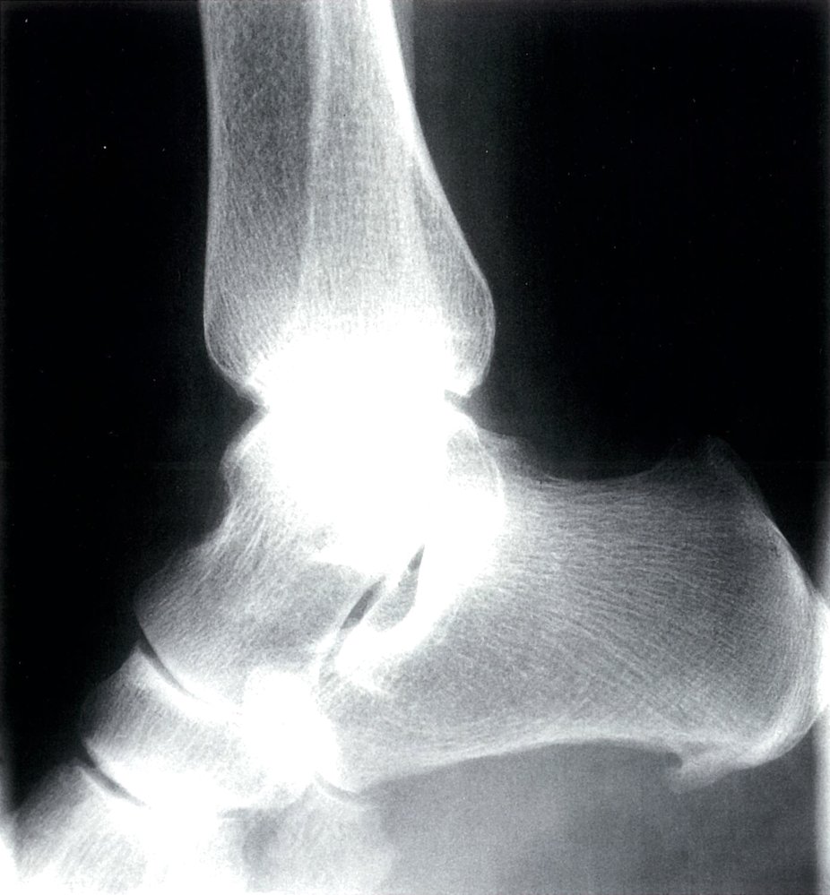 Plantar calcaneal spur