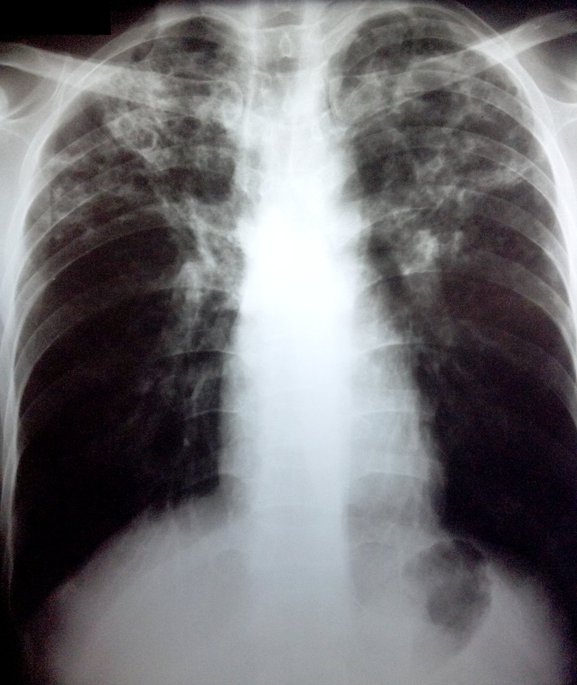 Bilateral upper lobe cavitary lung disease