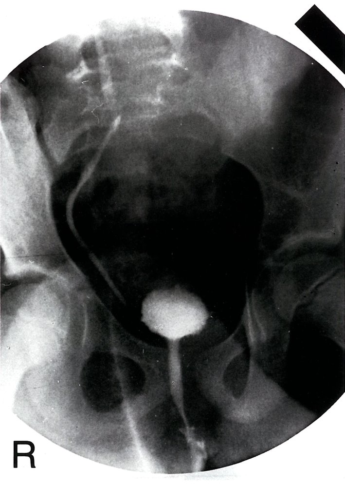 Vesicoureteral reflux