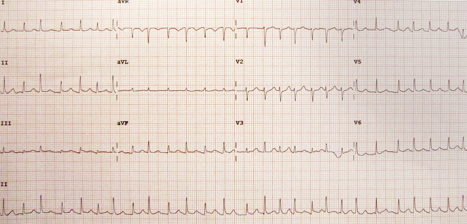 Electrical alternans