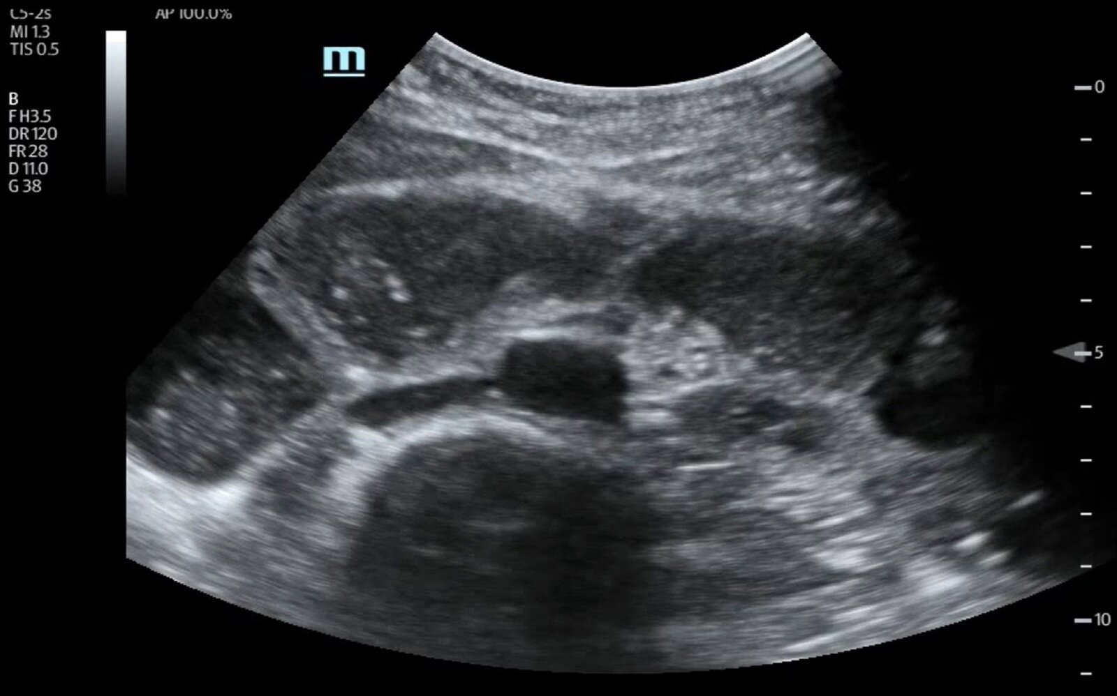 Dilated small bowel