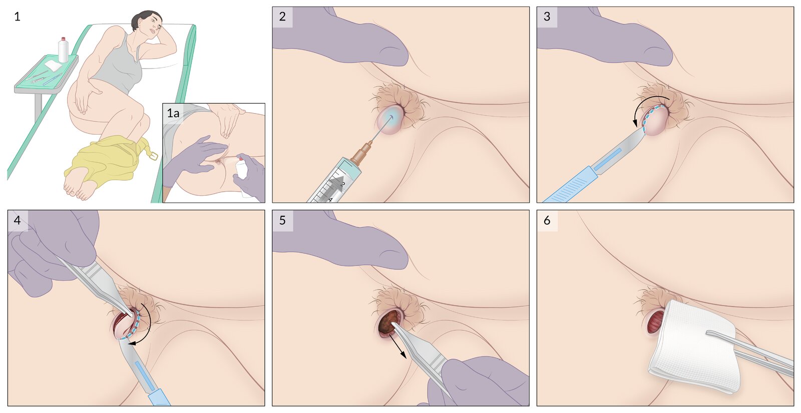 Excision of a thrombosed external hemorrhoid